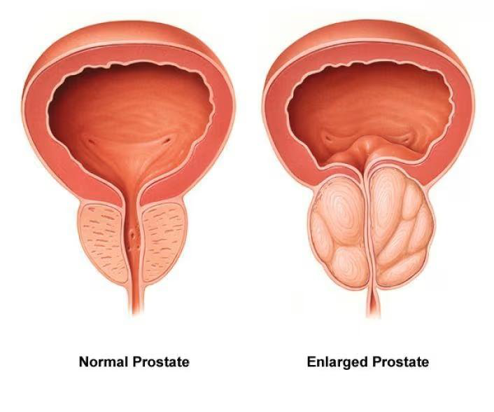 Comparison of a normal prostate and an enlarged prostate (BPH)